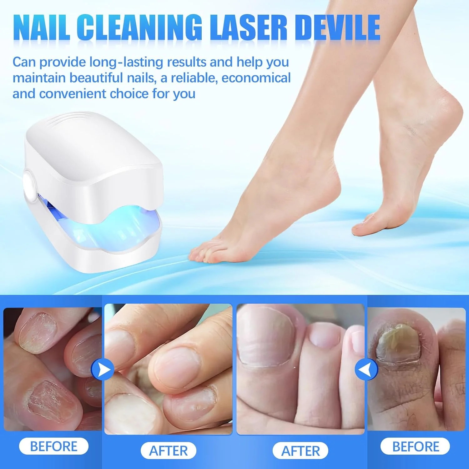 Rechargeable Nail Fungus Laser – Anti-Fungal Device Toenails, Hands & Feet (Home Use) - Image 6