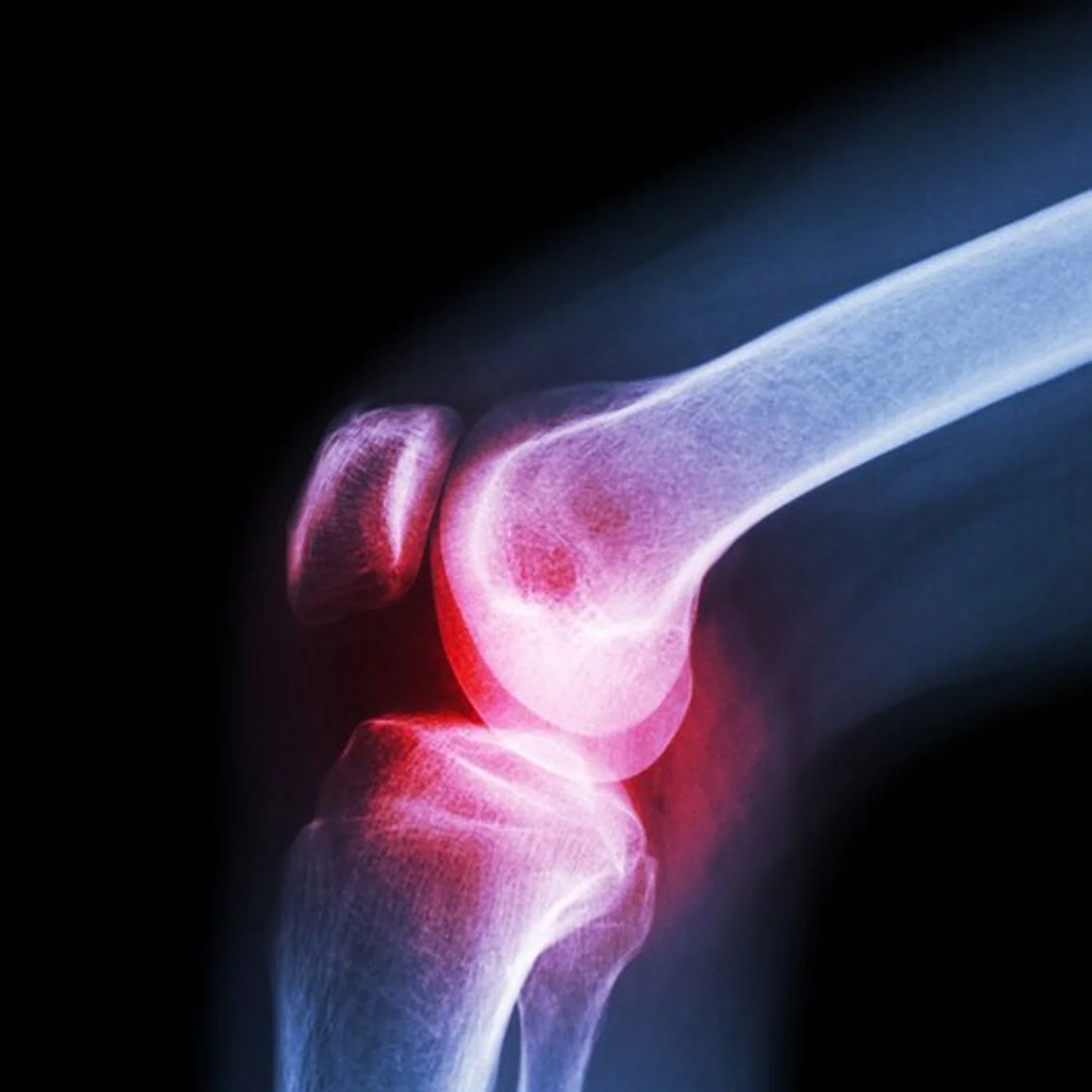 (XL) Knee Cap for Knee Support - Image 6