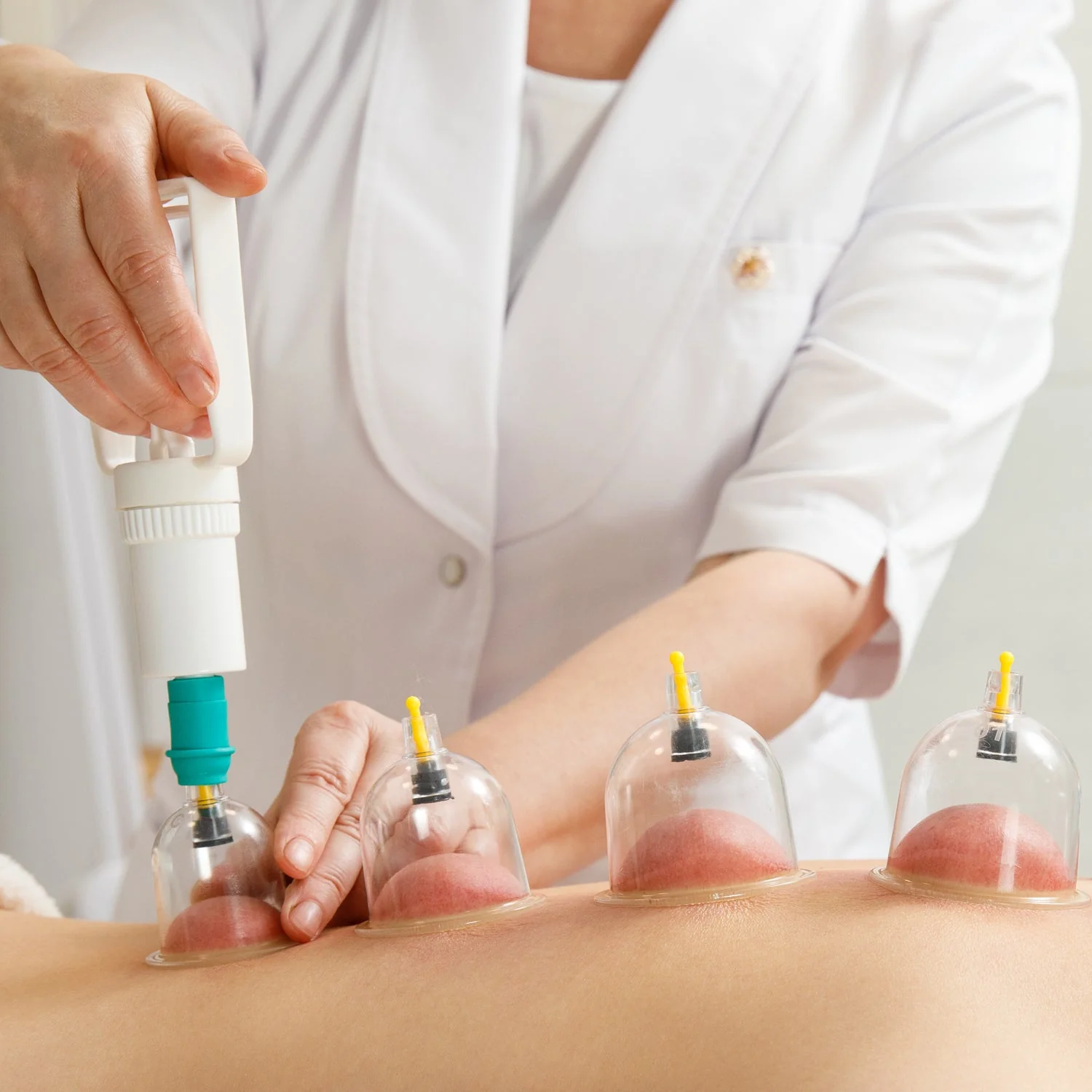 Vacuum Cupping Set – 6 Pc Massage Therapy Suction Kit for Relaxation - Image 3