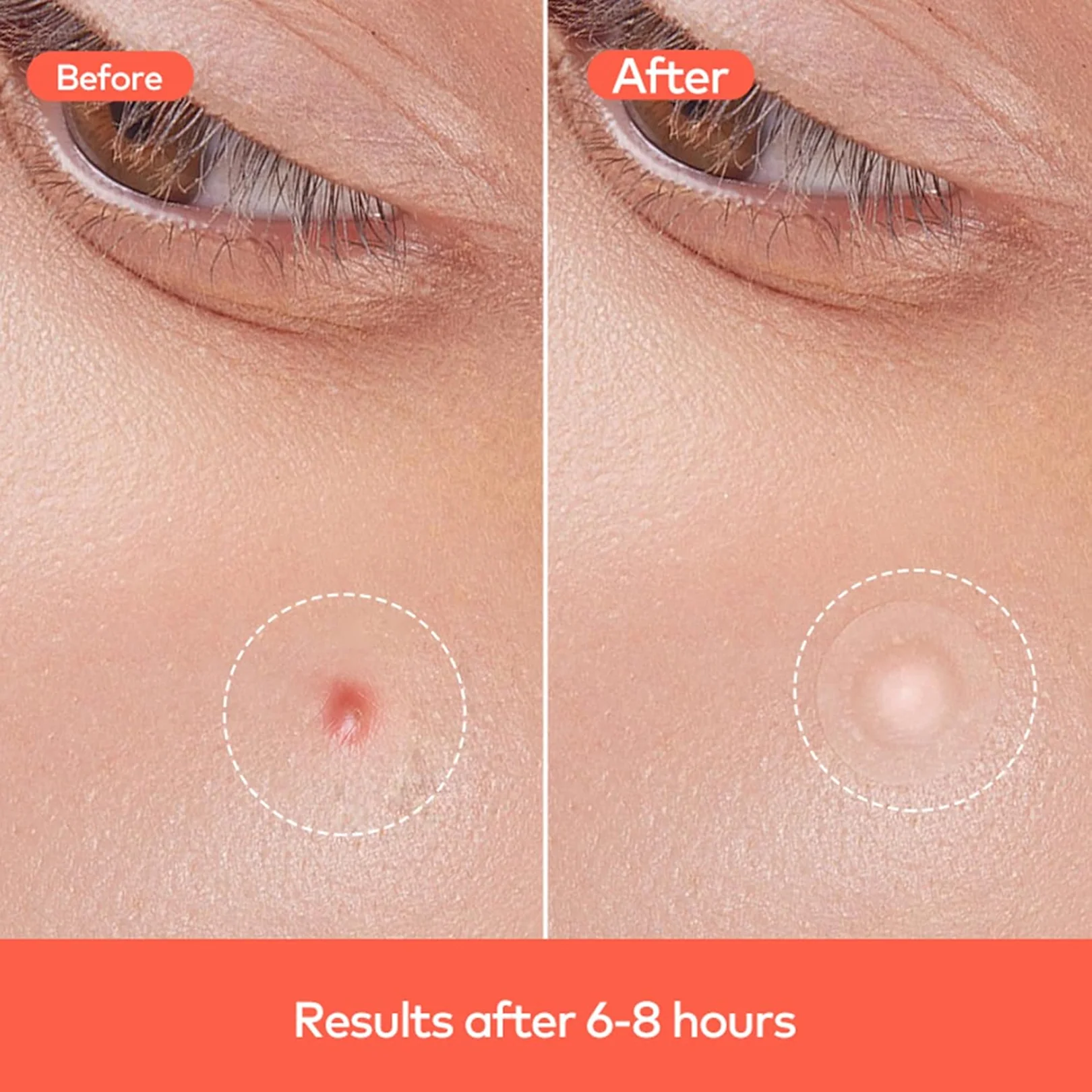 Pimple Patches for Face (1 Sheet Set) - Image 7